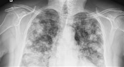 diplomado tratamiento del carcinoma microcítico de pulmón y otros tumores torácicos