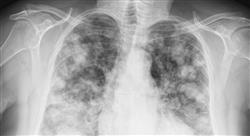 formacion tratamiento del carcinoma no microcítico de pulmón