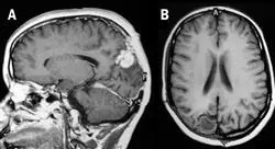 formacion puesta al día en patología neuroquirúrgica en neurología pediátrica