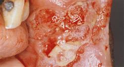 diplomado tumores de cabeza y cuello