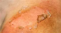 curso tumores de la piel