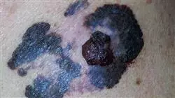 cursos oncologia especialidad tumores malignos