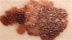 especializacion online oncologia especialidad tumores malignos