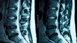 maestria online cirugia columna vertebral