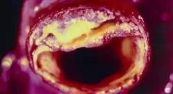 curso online ecografía vascular para atención primaria