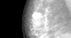curso online tratamiento radioterápico de tumores de mama
