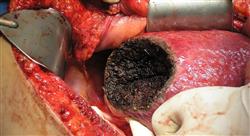 curso formacion continuada carcinoma hepatocelular