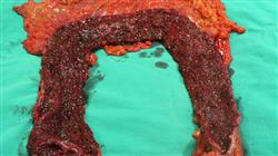 1 curso cirugia enfermedad inflamatoria intestinal
