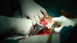 2 curso cirugia enfermedad inflamatoria intestinal