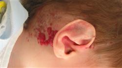 cfc online técnicas de imagen para diagnóstico, tratamiento láser y cirugía dermatológica pediátrica
