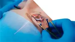 diplomado online cirugia refractiva corneal