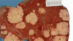 diplomado online diagnostico oncologia digestiva