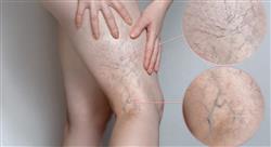 curso diagnóstico tratamiento y profilaxis de la enfermedad tromboembólica venosa