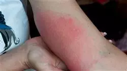 cursos patologia alergica