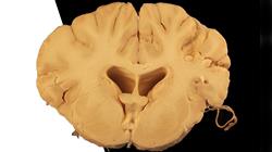 maestria neuropsicologia clinica Tech Universidad