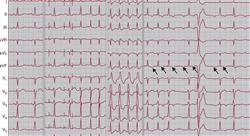 posgrado tratamiento cardioprotector y manejo del paciente complejo en cardiotoxicidad