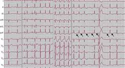 posgrado tratamiento cardioprotector y manejo del paciente complejo en cardiotoxicidad