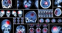 posgrado actualizacion neurologia Tech Universidad