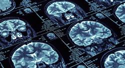 curso trastornos inflamatorios desmielinizantes sistema nervioso s