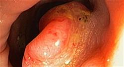 especializacion diagnóstico y tratamiento de tumores del tubo digestivo inferior