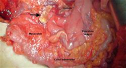 especializacion online diagnóstico y tratamiento de tumores del tubo digestivo inferior