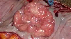 diplomado tumores de colon y recto