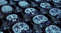 experto universitario manejo diagnóstico de los tumores cerebrales