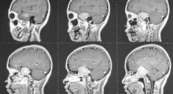 estudiar manejo de las metástasis cerebrales comorbilidades y complicaciones en el cáncer con afectación neurológica