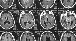 formacion manejo de síndromes paraneoplásicos y comorbilidades en el cáncer neurológico