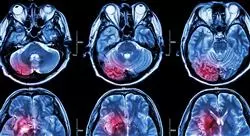 formacion manejo de las metástasis cerebrales y leptomeníngeas