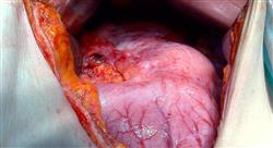 curso tumores del tubo digestivo superior