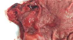 formacion tumores del tubo digestivo superior