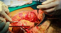 curso tumores pancreáticos biliares y hepáticos