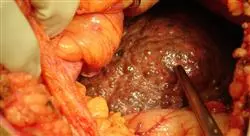 diplomado tumores pancreáticos biliares y hepáticos