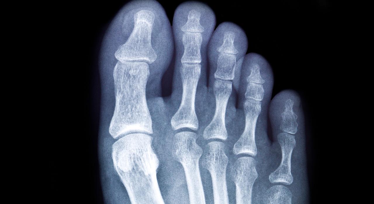 Ногтевой фаланги пальца ноги. Оскольчатый перелом пальца ноги рентген. Перелом основной фаланги 1 пальца стопы рентген. Перелом ногтевой фаланги большого пальца ноги на рентгене. Перелом фаланги пальца стопы рентген.