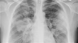 diplomado online salud publica enfermedad infecciosa urgencias