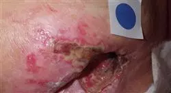 diplomado infecciones osteoarticulares piel y partes blandas en urgencias