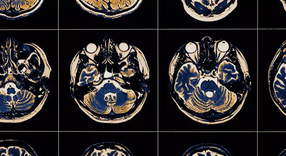 especializacion online abordaje fisioterápico del daño cerebral adquirido en geriatría para el médico rehabilitador