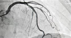 formacion síndrome coronario agudo (sca) en urgencias