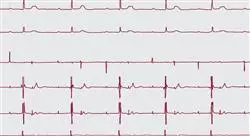 diplomado online arritmias y dispositivos de estimulación cardíaca: diagnóstico y manejo en fase aguda