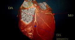 diplomado guías de actualización en patologías cardiaca aguda
