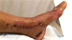 especializacion online terapeutica quirurgica lesiones deportivas pie tobillo