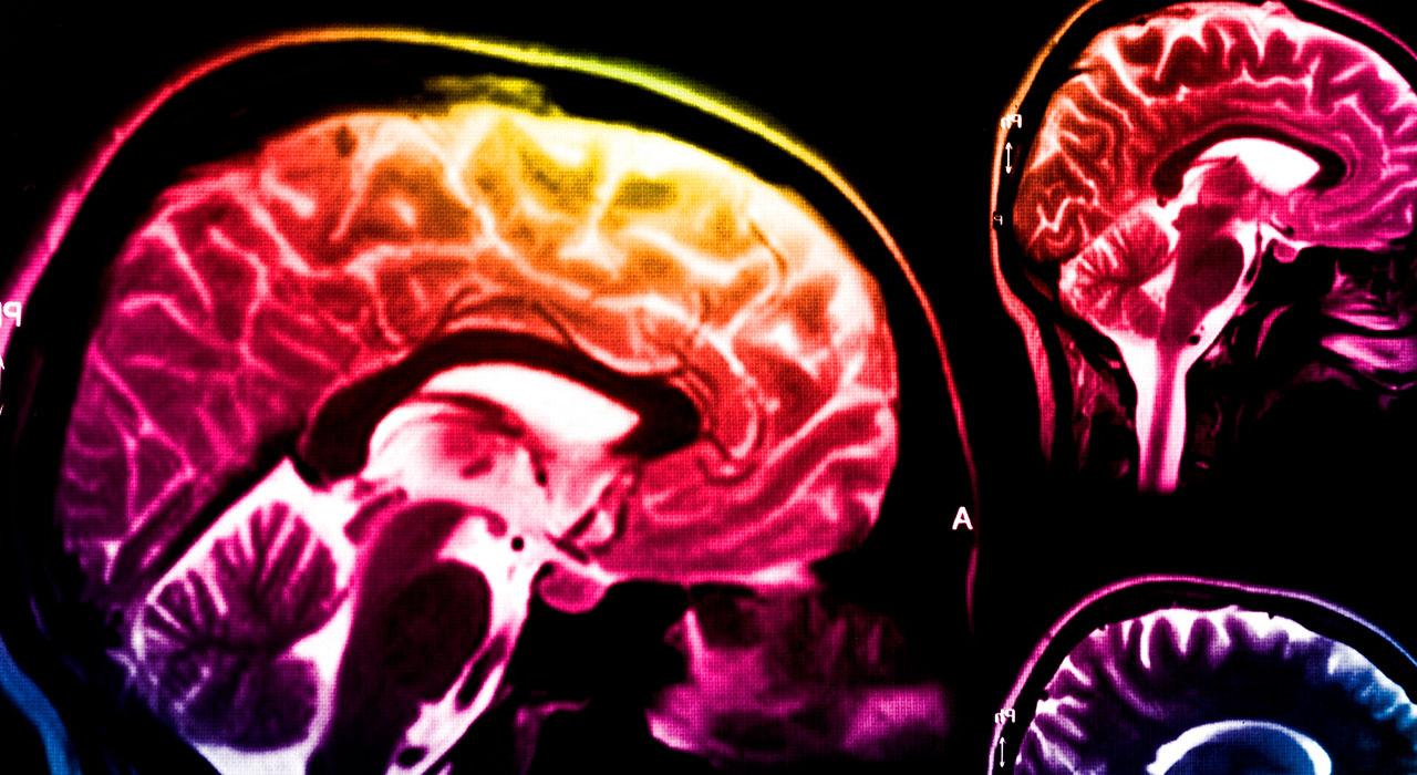 experto rm neuroimagen neuropatologia demencias 2 Tech Universidad
