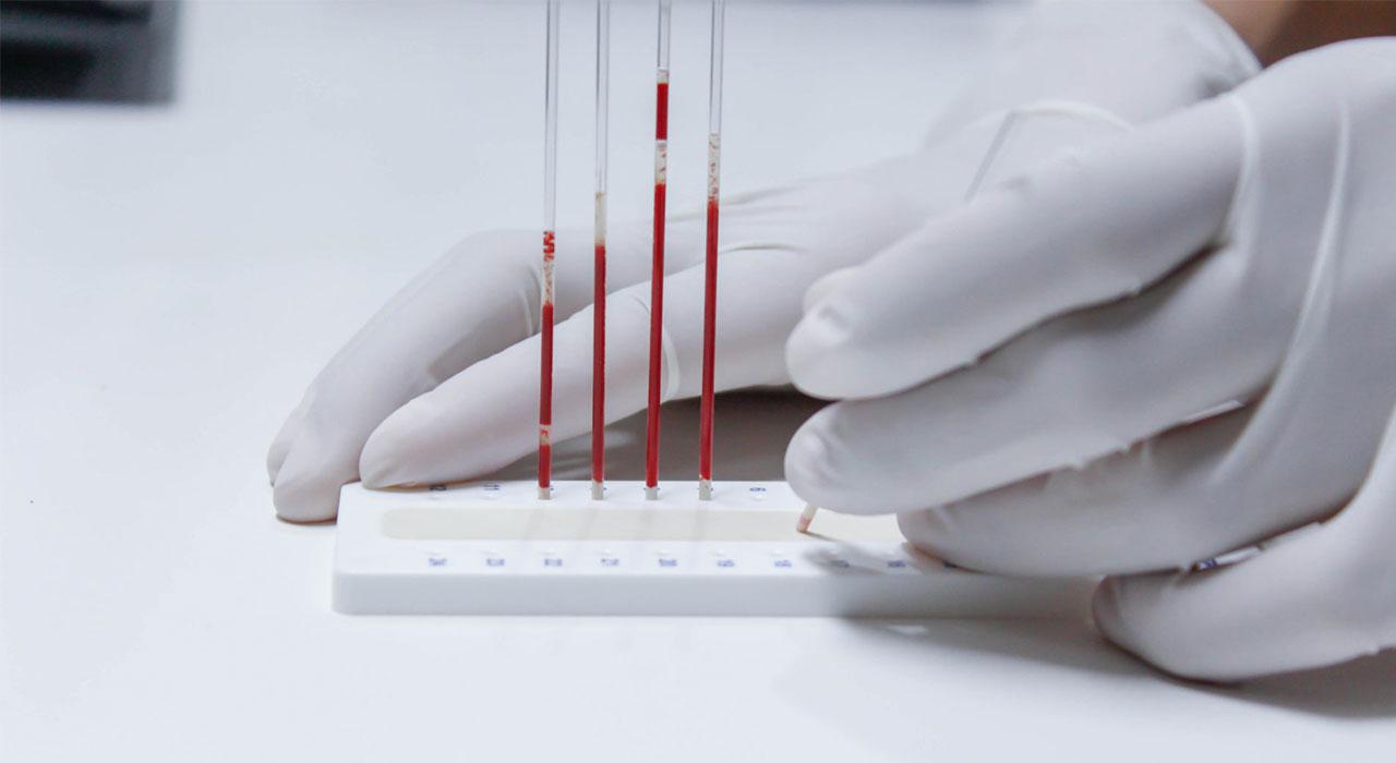 experto actualidad uso laboratorio hematologia terapeutica hematologica hemoterapia 2 Tech Universidad