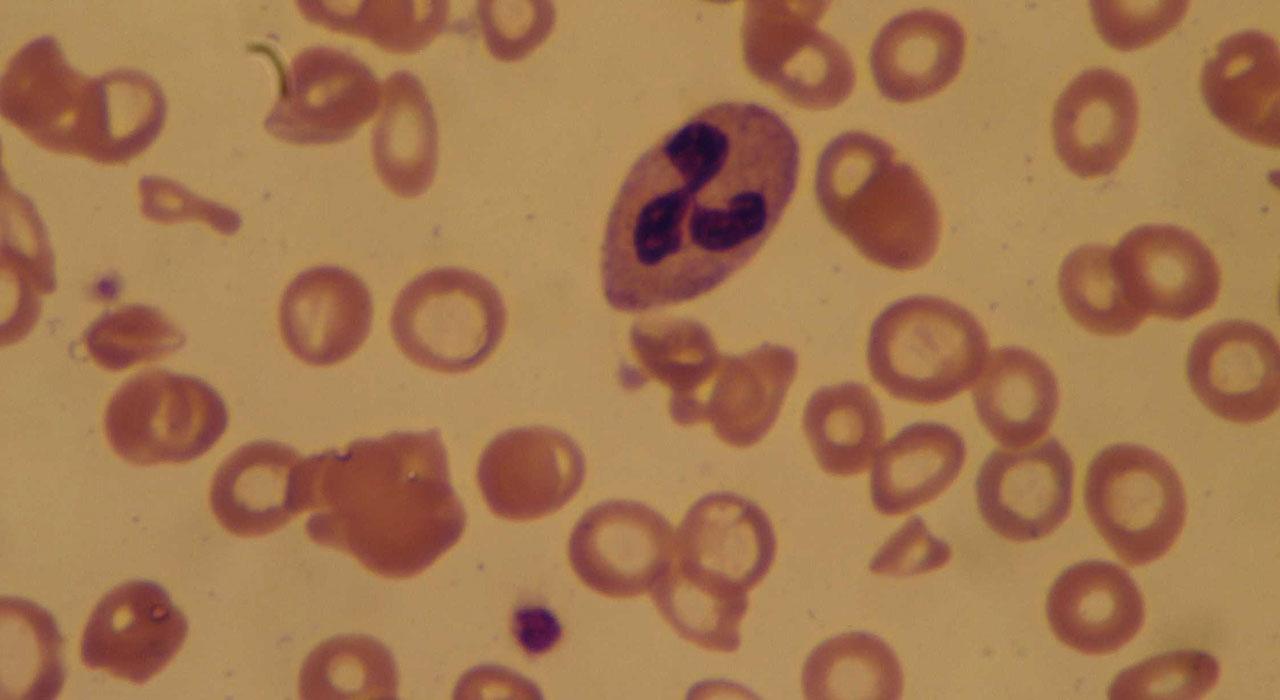 experto avances anemias trastornos medulares fisiologia hemostasia antihemorragicos 1 Tech Universidad