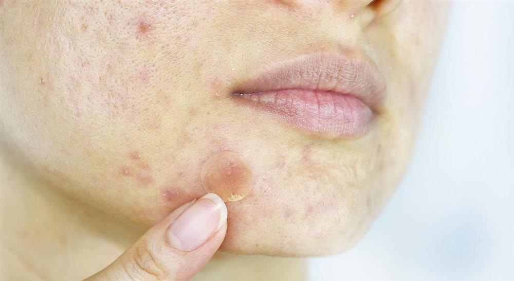 master tratamiento del acné
