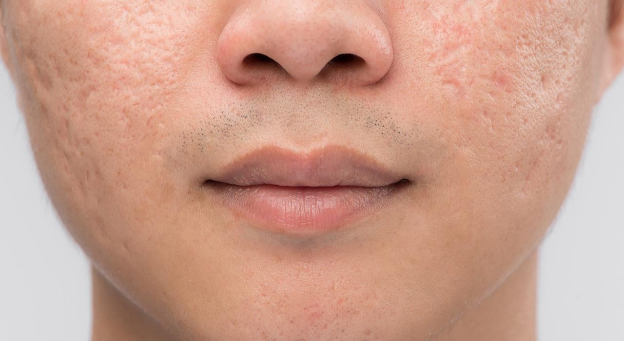 master tratamiento acne 2 Tech Universidad
