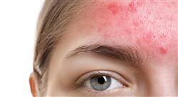 maestria online tratamiento del acné Tech Universidad