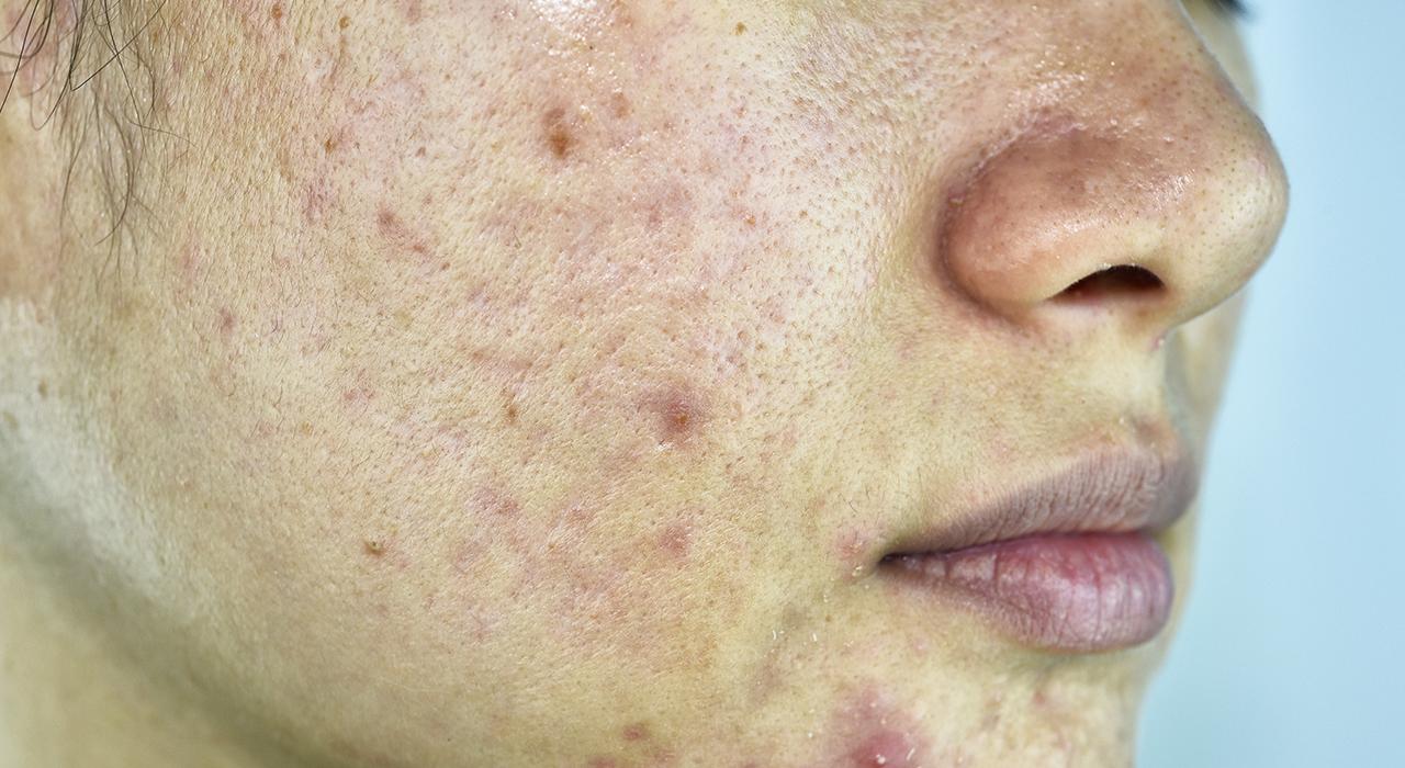 experto etiologia acne 1 Tech Universidad