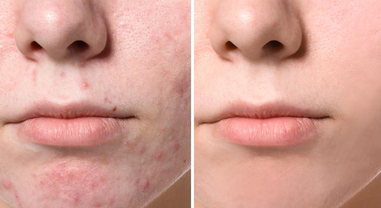experto etiologia acne 2 Tech Universidad